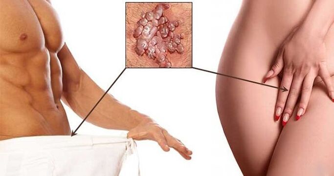 Condylomas in the genital area of ​​men and women