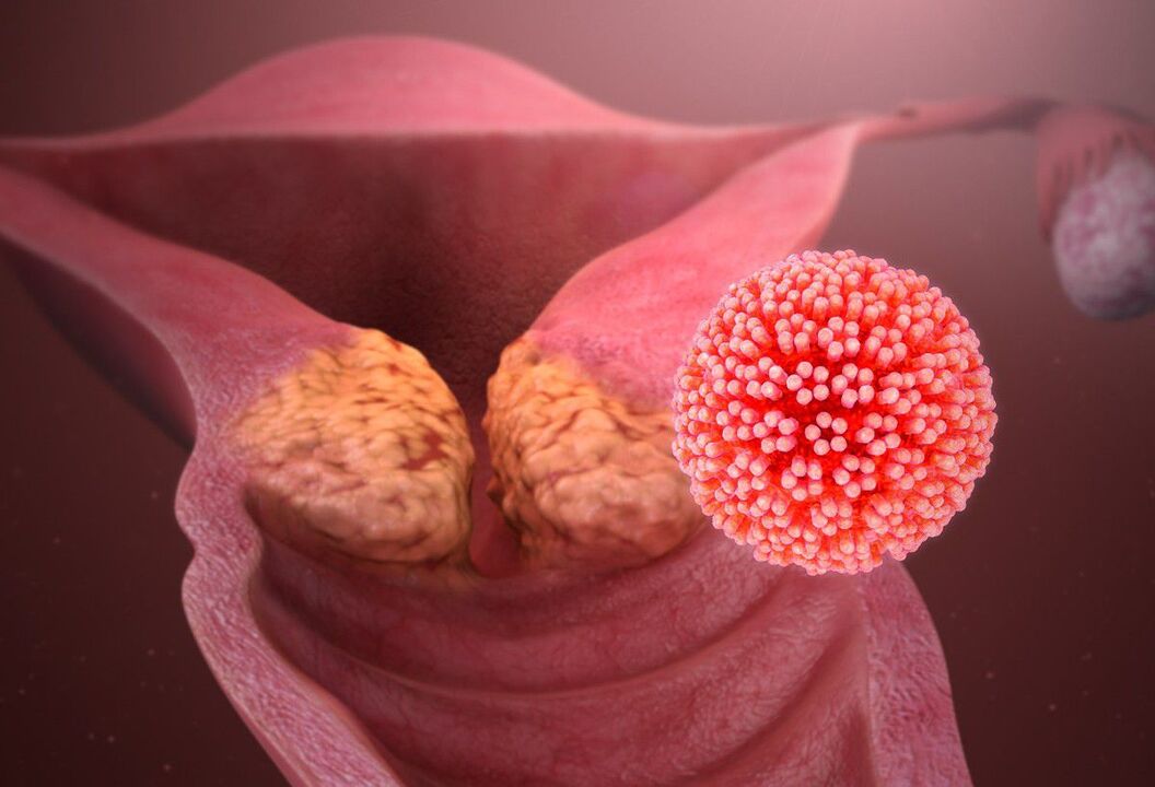 HPV lesion of the cervix