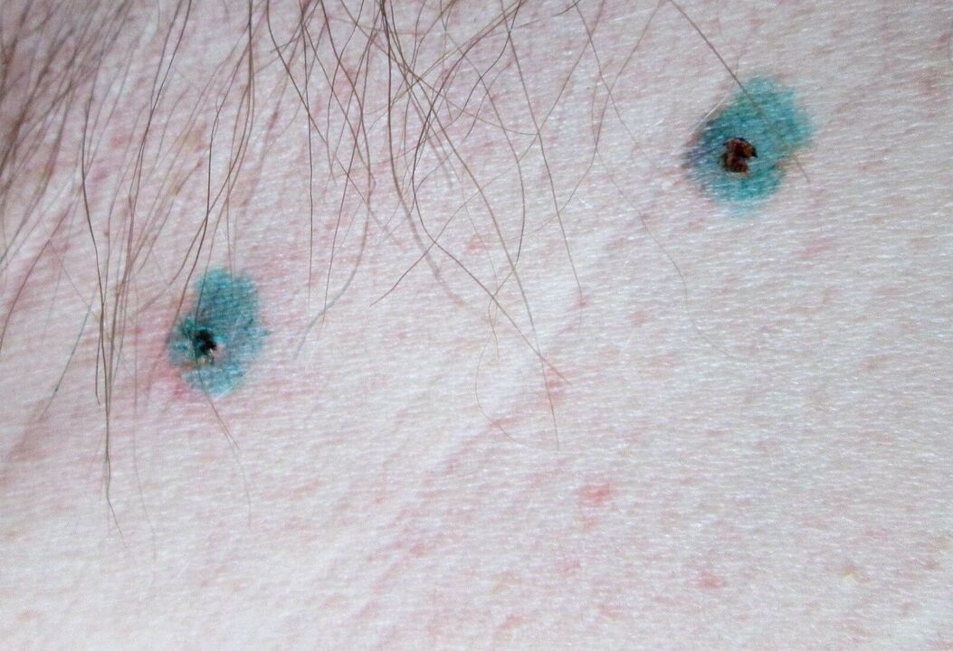 Spots on the skin after laser removal of papillomas